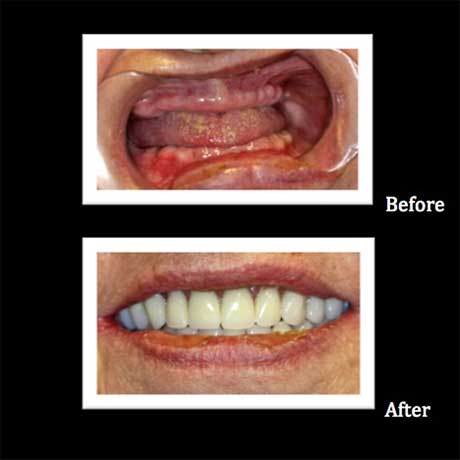 Granger Dentistry | Night Guards, Laser Dentistry and Inlays amp Onlays